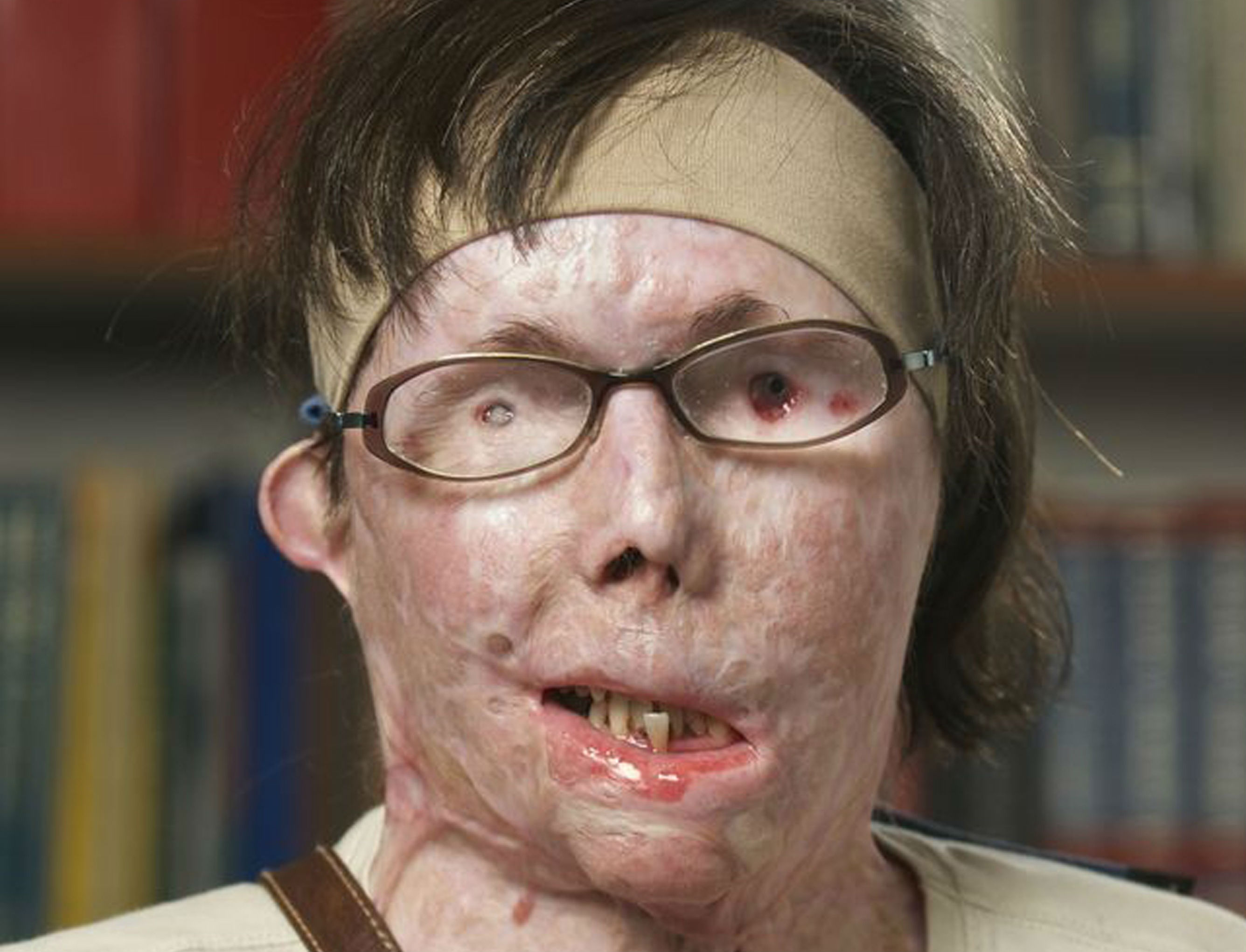 La crema per togliere lentiggini da una faccia